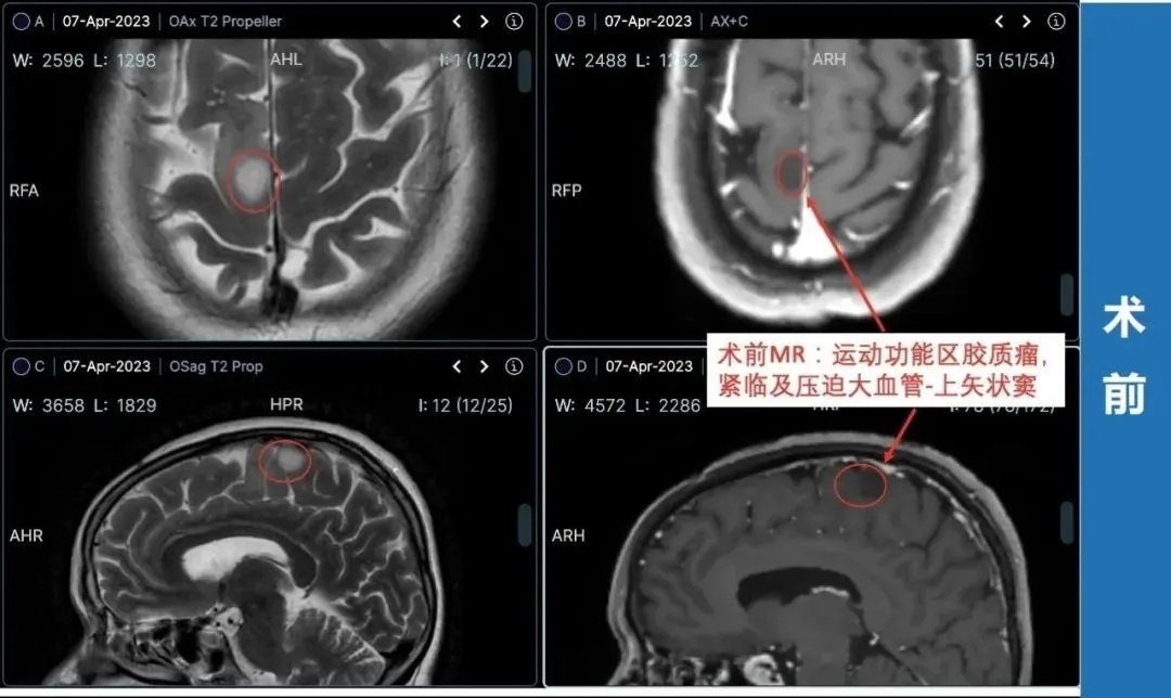 治疗过程：4月2日，罗女士和家人一致决定找巴教授手术，这时距离罗女士咨询巴教授仅过去了2天。