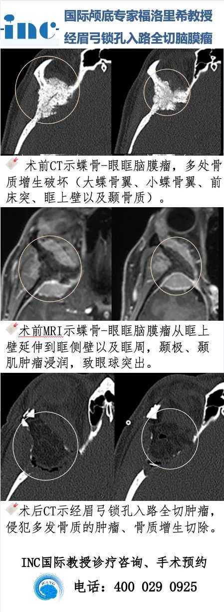 案例一：“经眉弓锁孔入路”全切蝶眶脑膜瘤