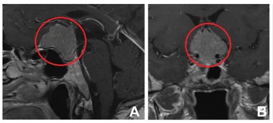 T1加权增强矢状面(A)和冠状面(B)磁共振成像显示鞍结节脑膜瘤。