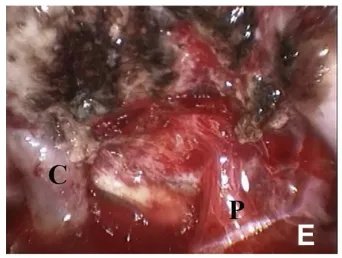 (E)30度内窥镜检查显示左侧颈内动脉(C)和垂体柄(P)，显微镜下未见。