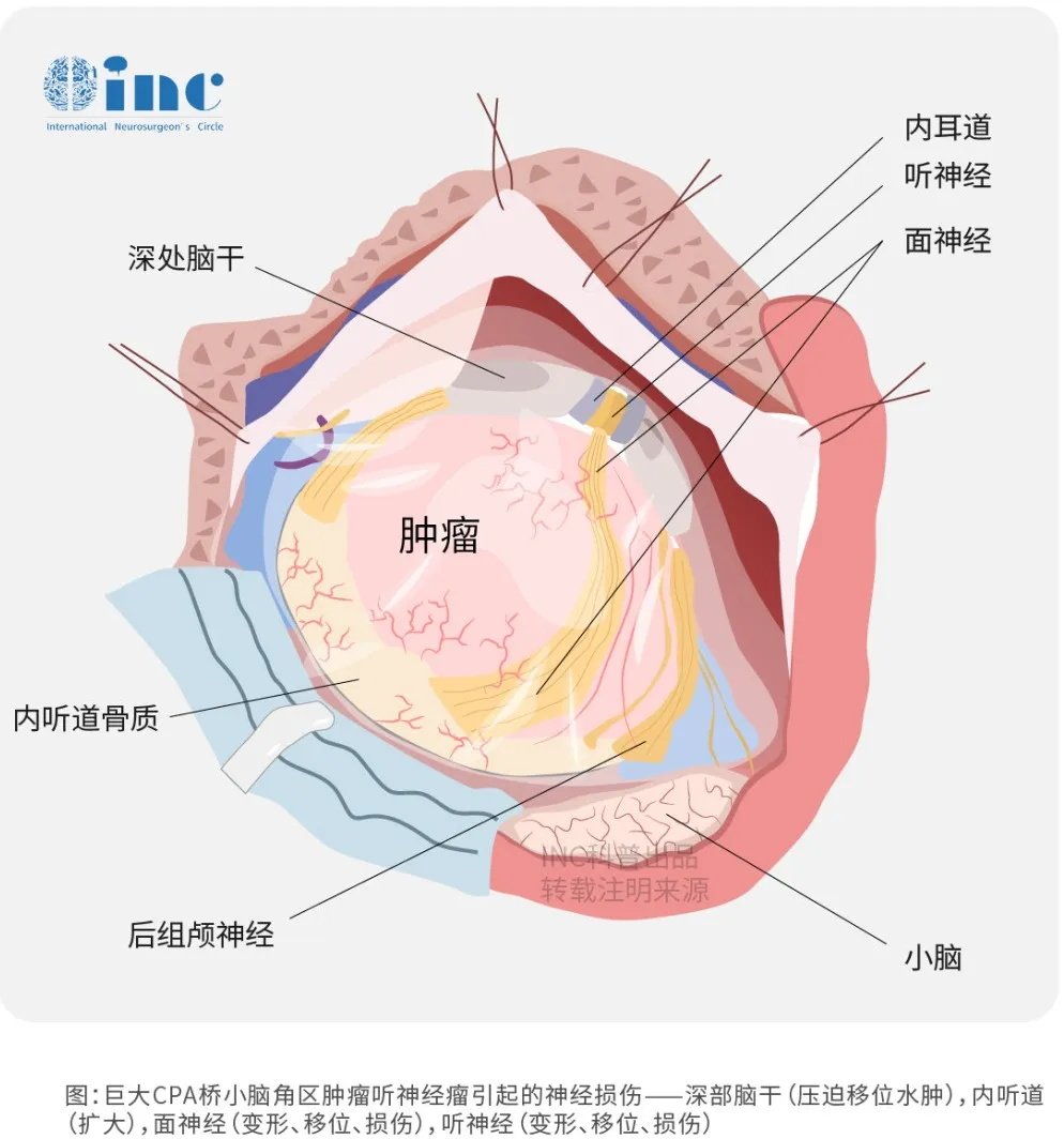 听神经瘤位于CPA区——小脑岩骨面包绕桥脑侧方形成该区域