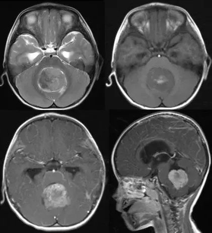 髓母细胞瘤典型影像