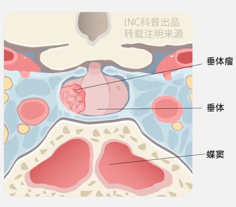 蓝色区域为海绵窦，海绵窦包围垂体复合体，包含颅神经(CNs)III、IV、V1、V2和VI，颈内动脉(ICA)的海绵段和颈动脉周围交感神经丛。颅神经III、IV和VI被蛛网膜鞘和蛛网膜颗粒包围，海绵窦内<a href='/bingzhong/naomoliu/' target='_blank'><u>脑膜瘤</u></a>由此产生。