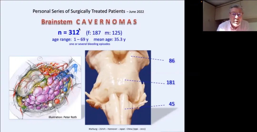 巴教授2022年于英国海绵状血管瘤联盟的课程讲演截图