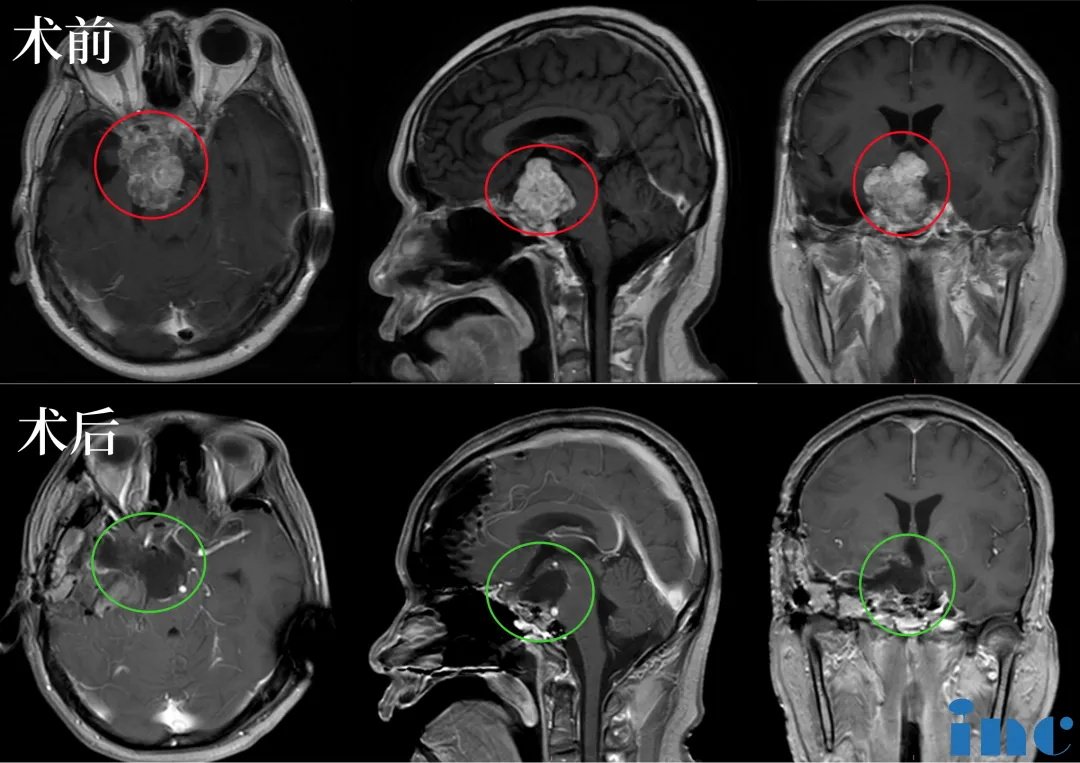 术前术后对比：手术顺利，术中将鞍上鞍内、海绵窦区、三脑室肿瘤切除