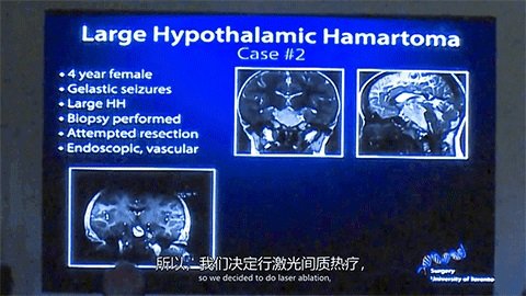 LITT技术消融元凶下丘脑错构瘤