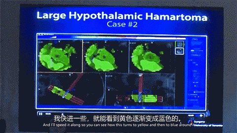 LITT技术消融元凶下丘脑错构瘤