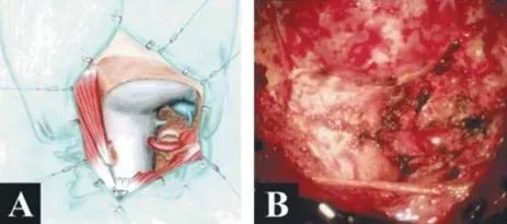 术中及肿瘤切除后的硬膜内部位