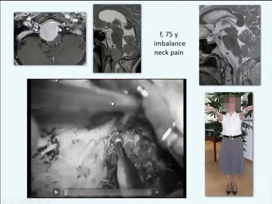 INC巴教授枕骨大孔区脑膜瘤精彩案例交流