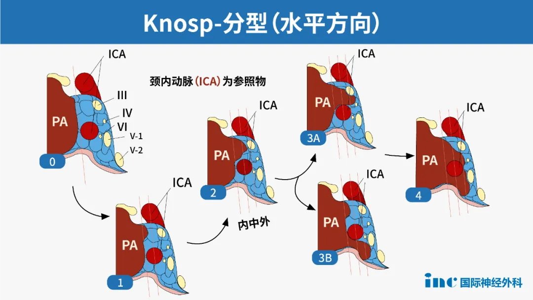 冠状位上通过颈内动脉内侧缘、中心、外侧缘作三条连线，通过评估垂体腺瘤与这三条线的关系做出分级分类