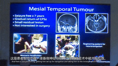 SickKids医院Rutka教授手术团队用Vario术中导航，然后准备行激光消融