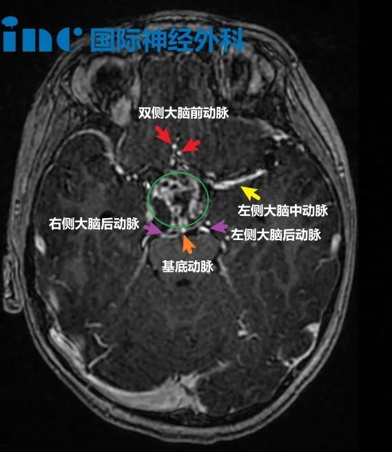 7岁男孩-鞍上区囊实性占位疑似颅咽管瘤  　　一次摔倒，竟然“摔”出脑肿瘤