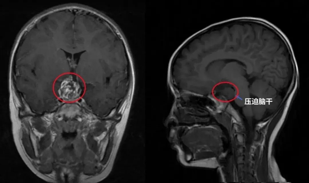 7岁男孩-鞍上区囊实性占位疑似颅咽管瘤  　　一次摔倒，竟然“摔”出脑肿瘤