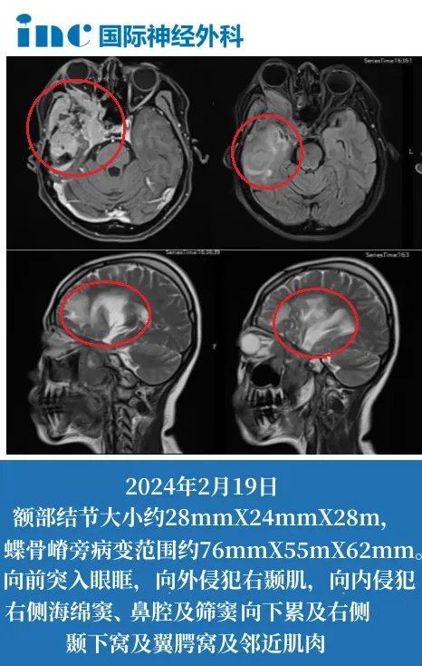 42岁女性-右侧颞部、蝶骨嵴旁脑膜瘤复发