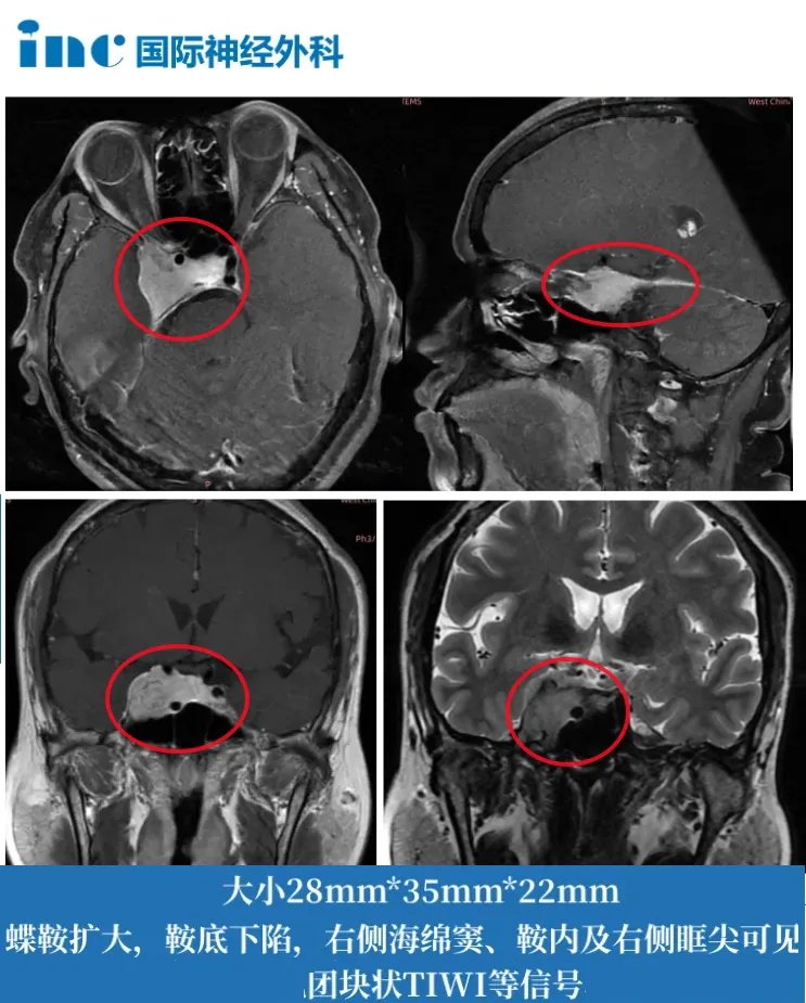 48岁女性-右侧海绵窦、鞍内及右侧眶尖脑膜瘤