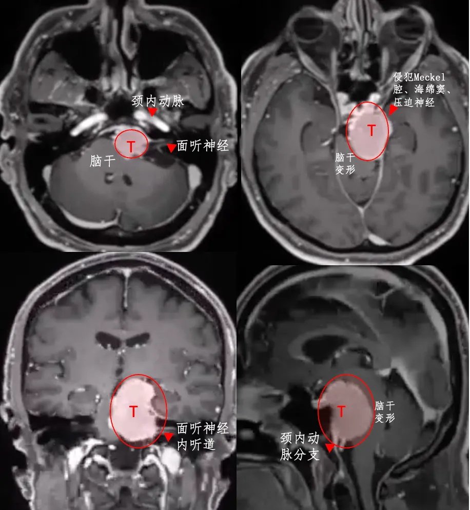 1.肿瘤位置深、体积大，已经压迫脑干；