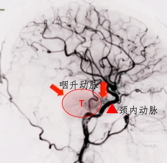 肿瘤被血管包绕，主要是咽升动脉和颈内动脉硬脑膜分支，术中易损伤出血