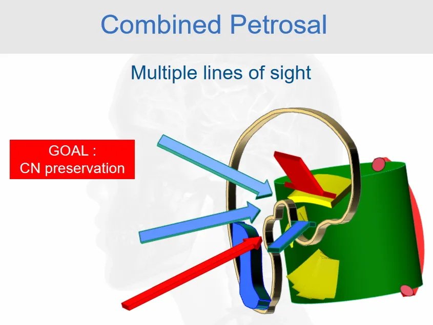 ▼联合岩骨入路：多条视线，目标是保护颅神经