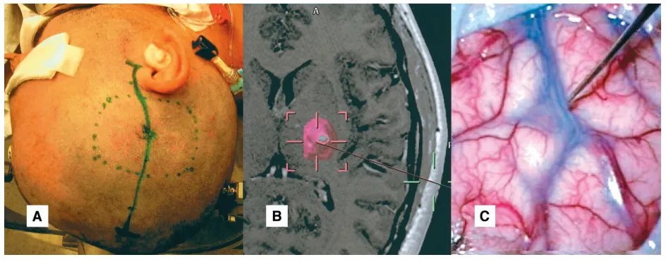 A、手术切口，根据海绵状血管瘤定位，如屏幕显示器(B)所示，(应患者要求，完全剃掉了头发，常规不需剔光头发)。C、在术中导航系统的帮助下识别定位外侧裂远端，并仔细解剖以暴露岛叶皮质。