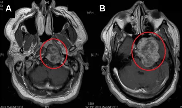 增强磁共振T1加权像显示颞下窝较大占位，肿瘤延伸至舌下神经管(HC)水平的咽后间隙。肿瘤向前侵犯蝶窦，并向后颅窝和中颅窝浸润，无硬膜内浸润。