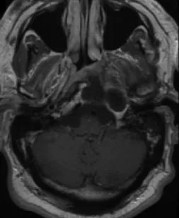 术后MR复查，显示颅中窝较大肿瘤已被切除，无新发神经损伤。