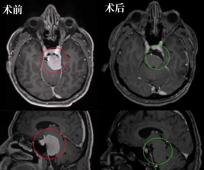 术后MRI显示肿瘤几乎完全切除，脑干受压解除。