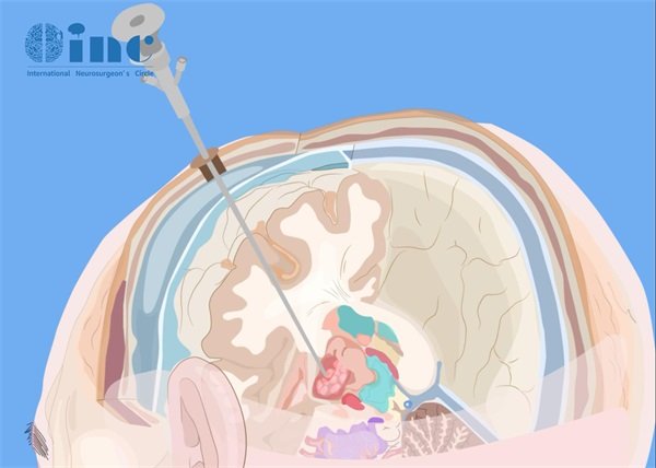 矢状窦旁纤维型脑膜瘤手术、生存期、复发和护理?