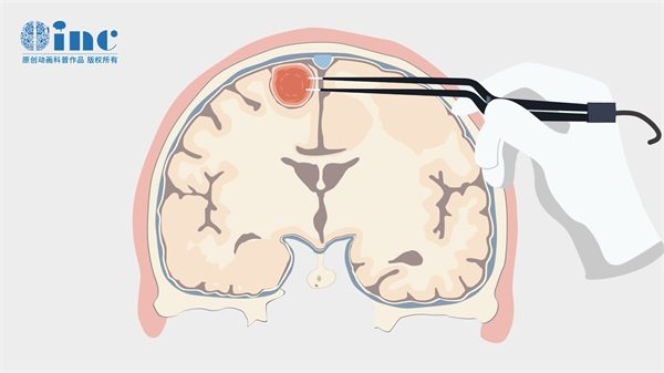 枕骨大孔区脑膜瘤手术费用大概多少