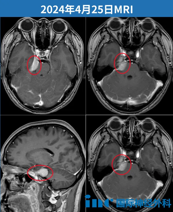 右侧桥小脑角区脑膜瘤