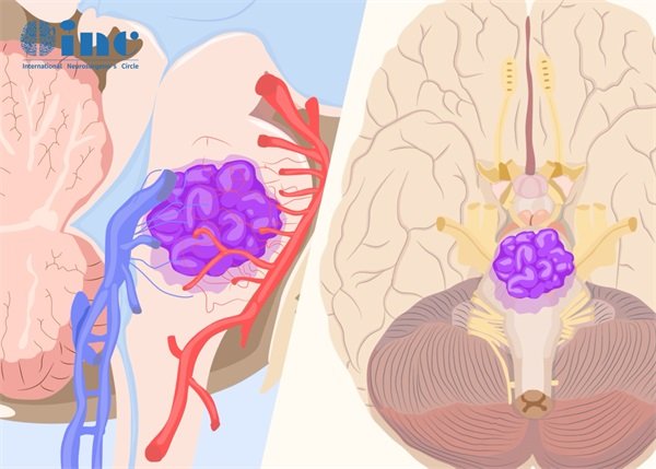 脑干海绵状血管瘤出血预测？