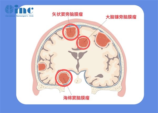 1.0厘米的脑膜瘤严重吗？