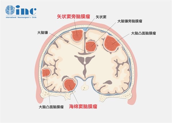 6厘米大脑膜瘤患者的生存期有多长？