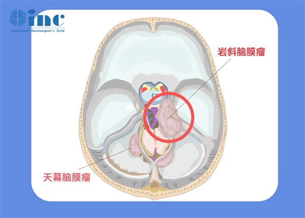 10厘米的脑膜瘤能活几年？