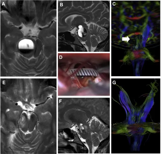 图1：妊娠期患者1的术前MRI(A-C)、术中视图(D)和术后MRI(E-G):轴向(A)和矢状(B)T2W图像显示右侧大型脑干CM病变。DTI(C)检测右侧皮质束和皮质脊髓束的移位。术中显微镜图显示CCM移除后的瘤腔(D)。