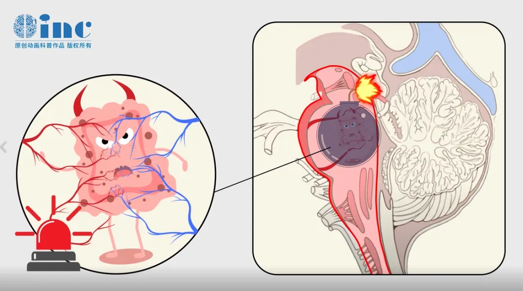 凶险的不定时炸弹“脑干海绵状血管瘤”