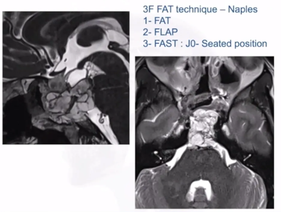 3F技术(Fat,Flap,Flash)：1、自体脂肪填充；2、皮瓣闭合；3、尽可能快地保持患者直立的姿势，以降低颅内压。有效降低脑积液发生率