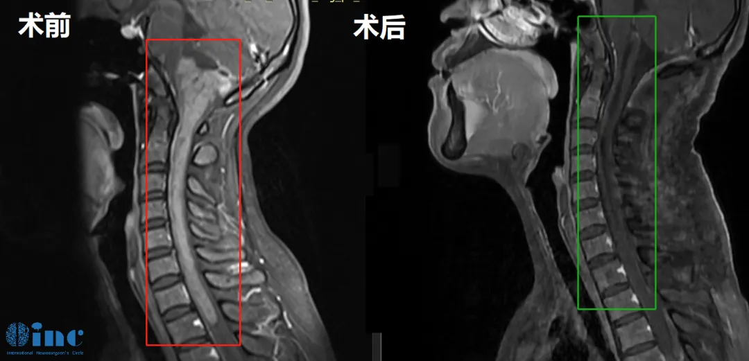 巴教授术前术后影像对比图片