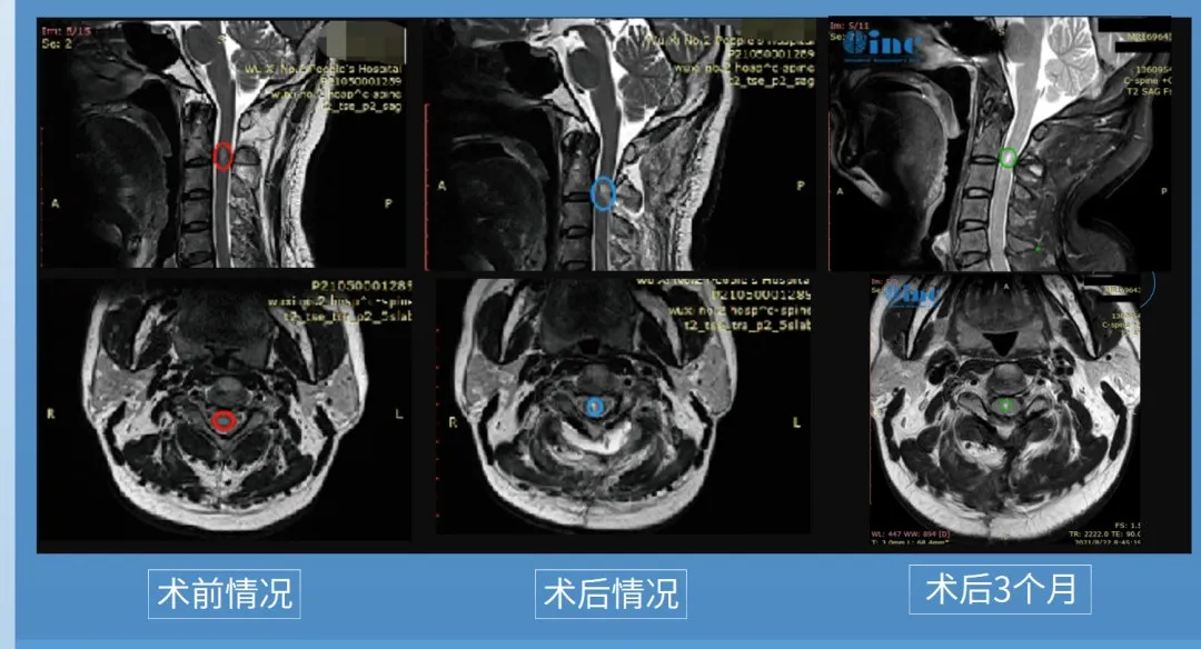 巴教授术前术后影像对比