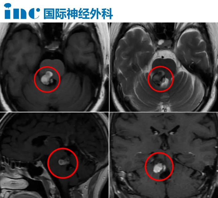 脑干海绵状血管瘤为什么凶险？多次出血严重吗？