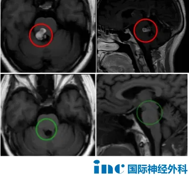 脑干海绵状血管瘤为什么凶险？多次出血严重吗？