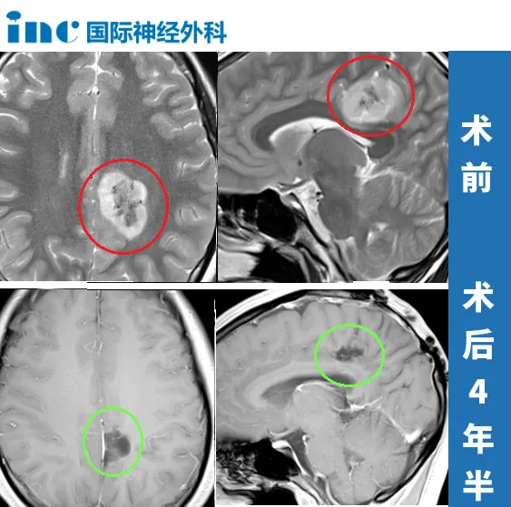 胶质瘤全切术后复发吗