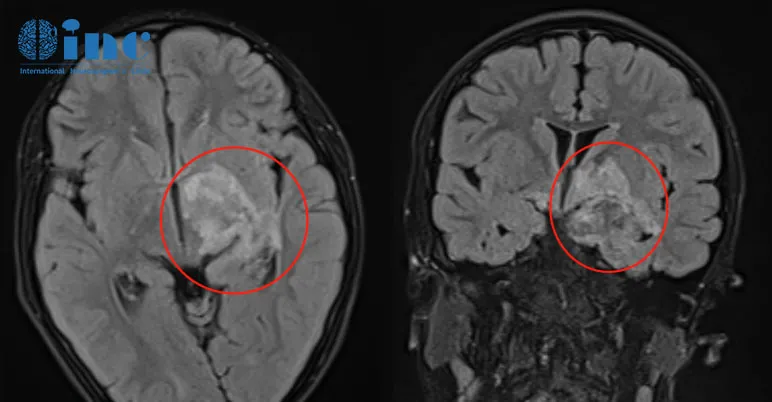 第一次术后MRI