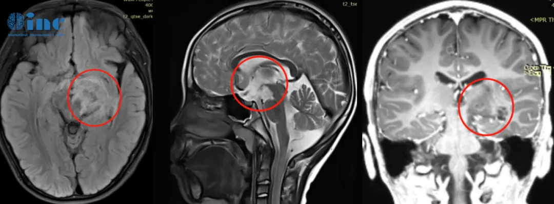 MRI显示肿瘤已延伸并浸润基底节和丘脑