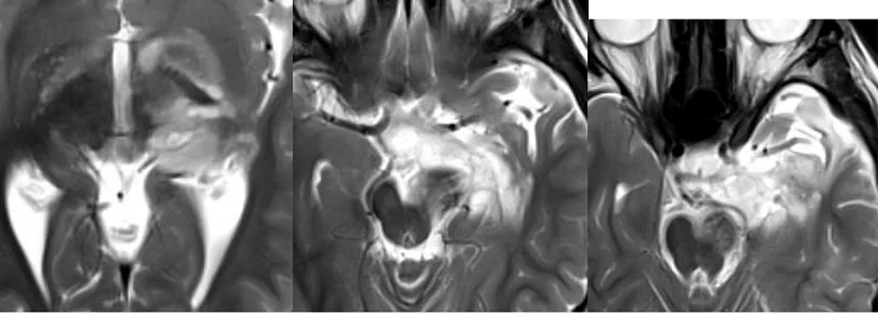MRI显示肿瘤已延伸并浸润基底节和丘脑