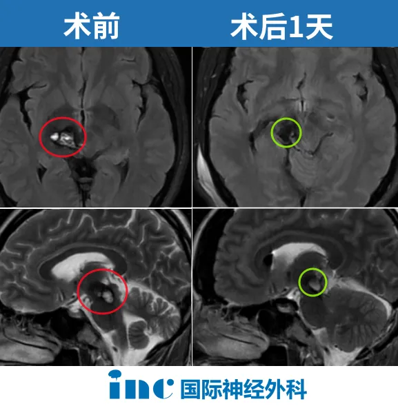 全切丘脑-中脑海绵状血管瘤，术后第1天四肢活动正常、术前症状即刻缓解