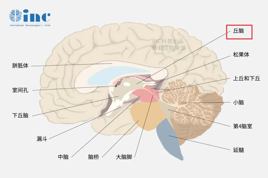 巨大丘脑及中脑海绵状血管瘤出血致偏瘫