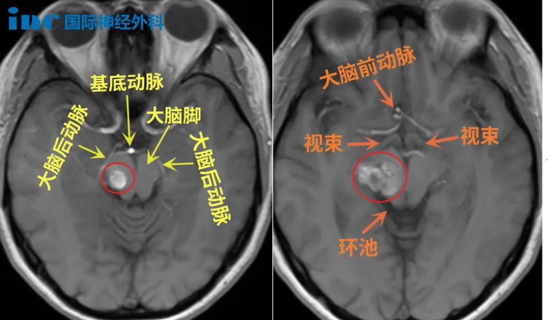 巨大丘脑及中脑海绵状血管瘤出血致偏瘫