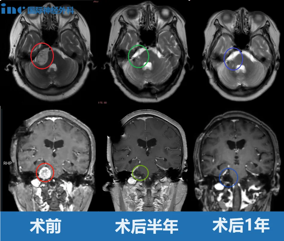 术后半年随访影像