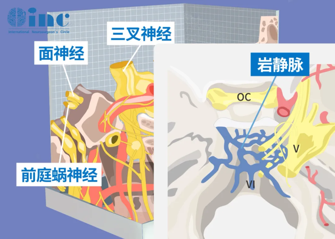 听神经瘤+脑积水