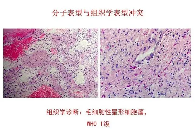 毛细胞性星形细胞瘤组织学形态